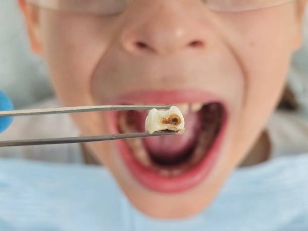 Best Emergency Broken Tooth Repair in Westmont, CA